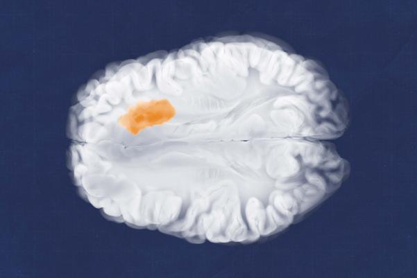 white brain orange hot spot