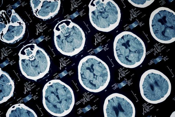 og_newsvirginiaedu_content_epilepsy-discovery-reveals-why-some-seizures-prove-deadly.jpg